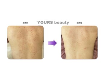ユアーズ ビューティー(YOURS beauty)/棘あり☆１回