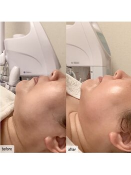 エムベル(M.belle)/リフトアップマッサージ施術前後