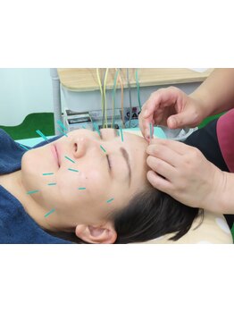 鍼灸施術を受けたい