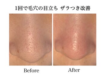 ナチュラーレ 天王寺店(Naturale)/美肌ニキビケア小顔フェイシャル