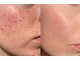 マリヴェリーテ(Mari verite)の写真/男性ニキビ/赤みに。肌悩み経験者×歴13年の本格肌質改善♪本気でお肌を変えたい方に自信のもてる素肌へ。