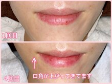 ララン(Laran)/ハイドラ&フォト