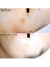 メゾリーナ(MAISOReNA)/水光ピーリング