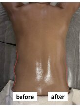 ゼロミリメートル(0mm)/【インディバ】ビフォーアフター