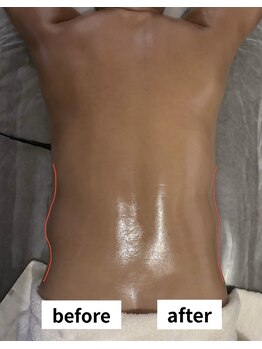 ゼロミリメートル(0mm)/【インディバ】ビフォーアフター