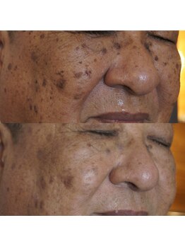 エトル(etole)/70代お客様症例写真