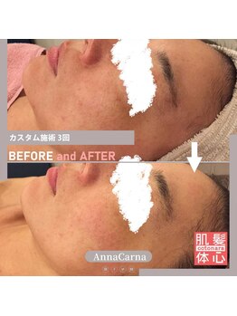 アンナカルナ(AnnaCarna)/キメを整えることから肌質改善