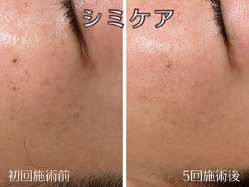 シエナ(ciena)/『シミケア5回』　症例写真♪