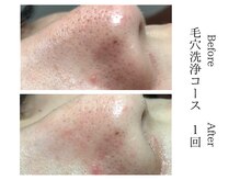 メンズミーシェ(Men's Meshie)/フェイシャルエステ