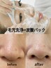 【毛穴＆美白】4step全顔毛穴洗浄+濃密美容炭酸パック1回¥6000
