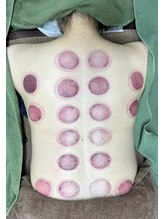 あさひ鍼灸マッサージラボ 成増院/吸玉（カッピング）