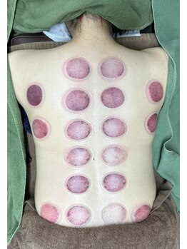 あさひ鍼灸マッサージラボ 成増院/吸玉(カッピング)