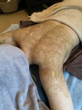 リラ 都城店(Lilas)/ハーブピーリング背中