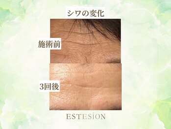 エステシオン(ESTESiON)/深くなったシワの変化