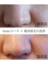 エン(EN。)/超音波毛穴洗浄＊施術症例