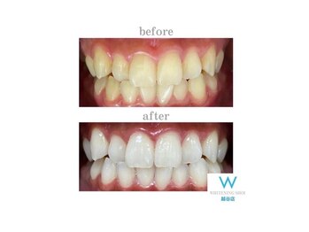 ホワイトニングショップ 越谷店/before&after美白ホワイトニング