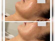 プライベートエステティックサロン クール(Coeur)/【光de透明美白コース】