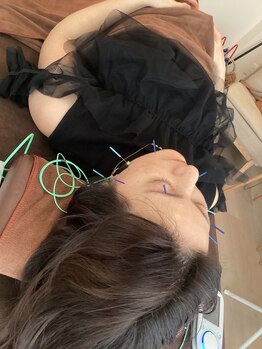 ハリファ鍼灸院 横浜関内院(HariFa鍼灸院)/美容鍼施術/美容鍼