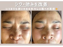 チャンティック(Cantik)の雰囲気（肌質改善コースの幹細胞美容液導入でぷるぷるお肌を手に入れる♪）