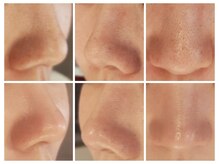 ベリッセ(Belisse)/ハイドラ毛穴洗浄