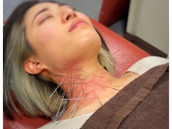 船橋はりきゅう整骨院/ルート鍼/肩こり/整体/船橋/腰痛