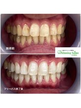 ホワイトニングサロン 名古屋駅店/【ホワイトニング施術例】