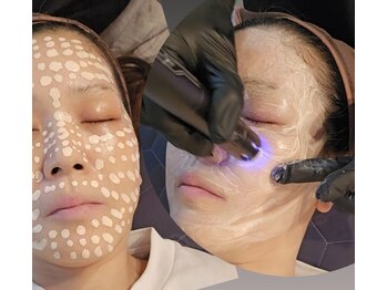 水光ピールスキン