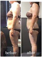 ピーラトゥ 日立(P-Ratu)/脂肪冷却◆