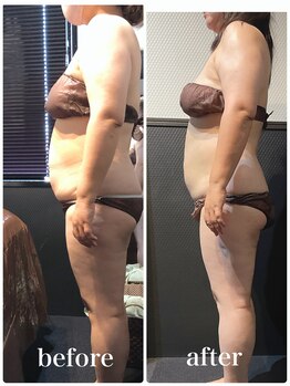 ピーラトゥ 日立(P-Ratu)/脂肪冷却◆