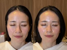 アンティアージュ 福岡本店(antiage)/年齢とともに気になるたるみに