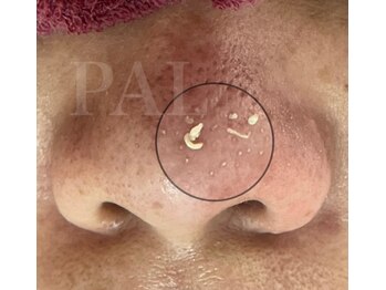 パル(PAL)/毛穴エクストラクション