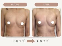 ウェルバスト(Well Bust)/【バストアップ例】E→Gカップ