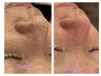 リジュベ(Rejuve)/毛穴洗浄/毛穴エステ/船橋毛穴