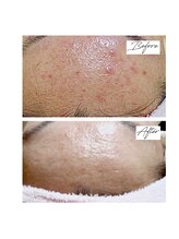 ビズビズ 梅田店(bisebise)/背中ニキビ/ハイドラ毛穴洗浄