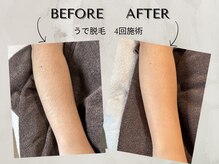 ワンアップ(One-up)/肘下脱毛 ４回　before　after