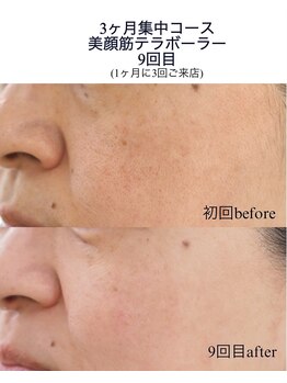 ベルフィーヌ ノーブル(BELLEFINE noble)/美顔筋テラボーラー即効小顔