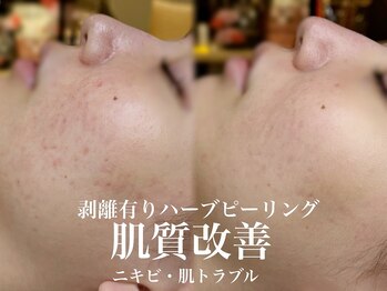 サロン ムスブ(salon MUSUBU)/剥離有りハーブピーリング