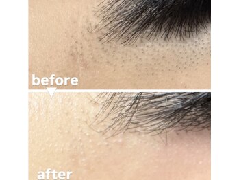 メゾン ド クロエ(Maison de Chloe)/【他店お直し】毛穴レス