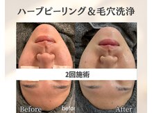 イーラボ 池袋店(e-LABO)/毛穴洗浄×国産ハーブピーリング