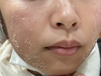 ウェクシー(WECXII)/剥離ハーブで感動の美肌に