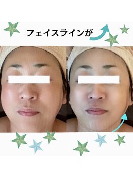 メディカルサロン かとれあ/リフト希望！