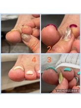 ミイア 春日部店(MiiA)/巻き爪改善ジェル　初回¥8,800