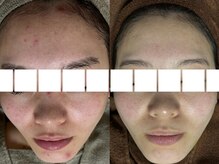 リボーン(REBORN)/肌育するならハーブで決まり！