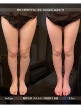 凛玄 名古屋栄店(りんげん)/脂肪冷却 Before After