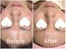 ジョアアンジェ 京橋店(joie ange)/気になる赤みを徹底ケア