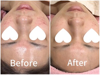 ジョアアンジェ 京橋店(joie ange)/気になる赤みを徹底ケア