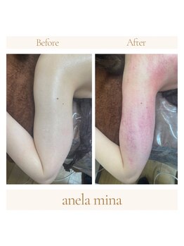 アーネラミーナ(Anela mina)/施術例