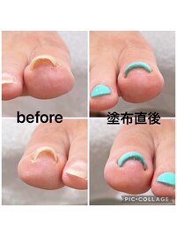 巻き爪改善ジェル　初回¥8,800
