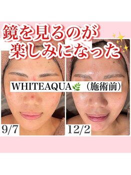 ホワイトアクア 姫路店(WHITE AQUA)/ハーブピーリング/肌荒れ/美肌