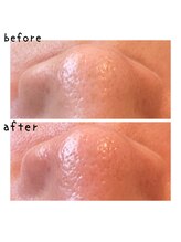 ニコリ(nicori)/ワックス脱毛で毛穴洗浄